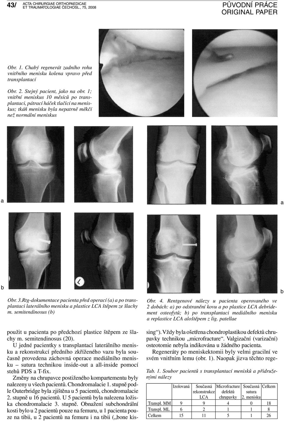 Rtg-dokumentace pacienta před operací (a) a po transplantaci laterálního menisku a plastice LCA štěpem ze šlachy m. semitendinosus (b) Obr. 4.