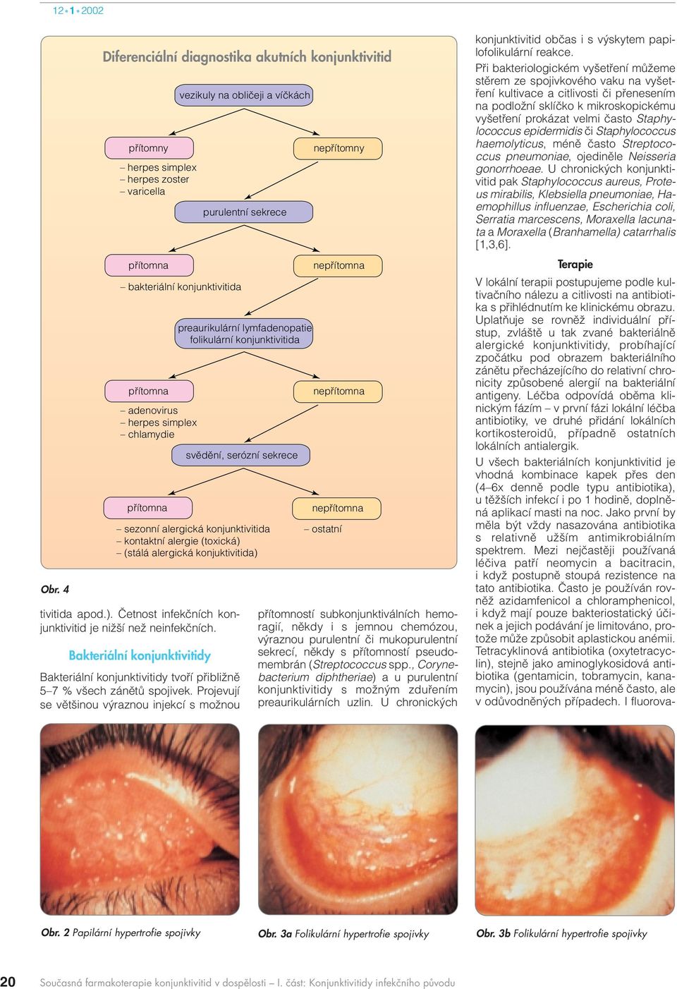 Projevují se vût inou v raznou injekcí s moïnou vezikuly na obliãeji a víãkách bakteriální konjunktivitida adenovirus herpes simplex chlamydie purulentní sekrece preaurikulární lymfadenopatie