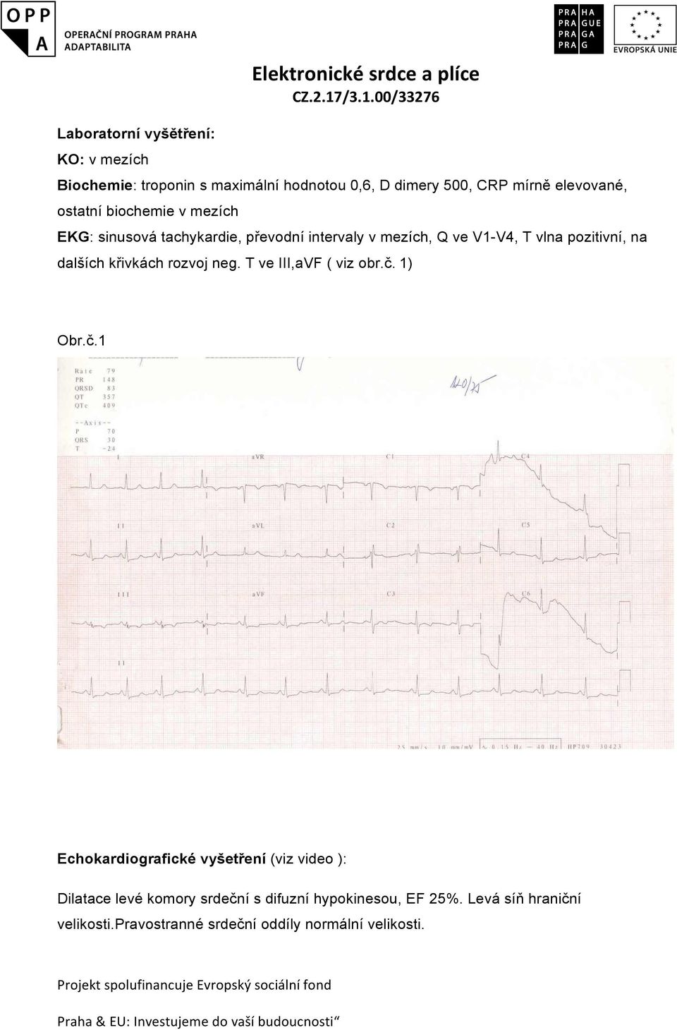 T ve III,aVF ( viz obr.č. 1) Obr.č.1 Echokardiografické vyšetření (viz video ): Dilatace levé komory srdeční s difuzní hypokinesou, EF 25%.