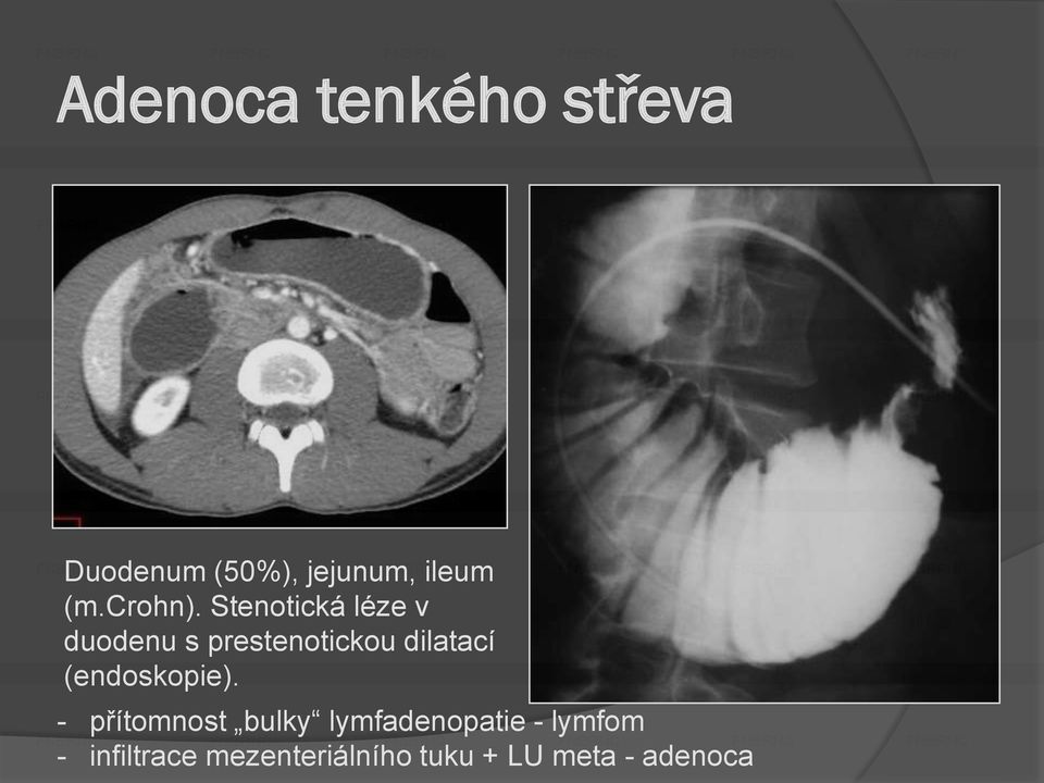 Stenotická léze v duodenu s prestenotickou dilatací