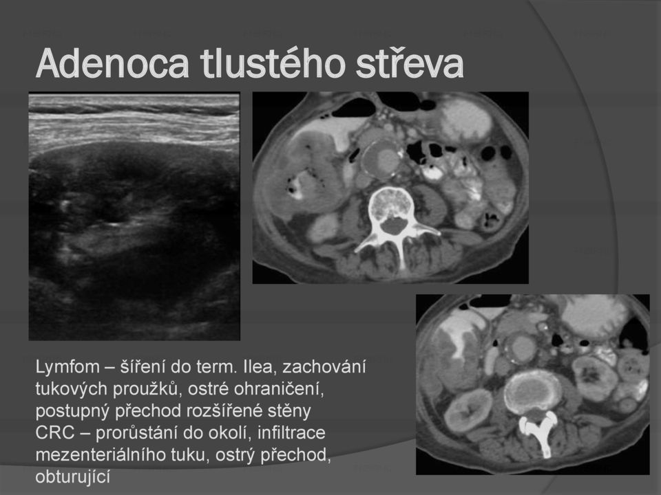 postupný přechod rozšířené stěny CRC prorůstání do