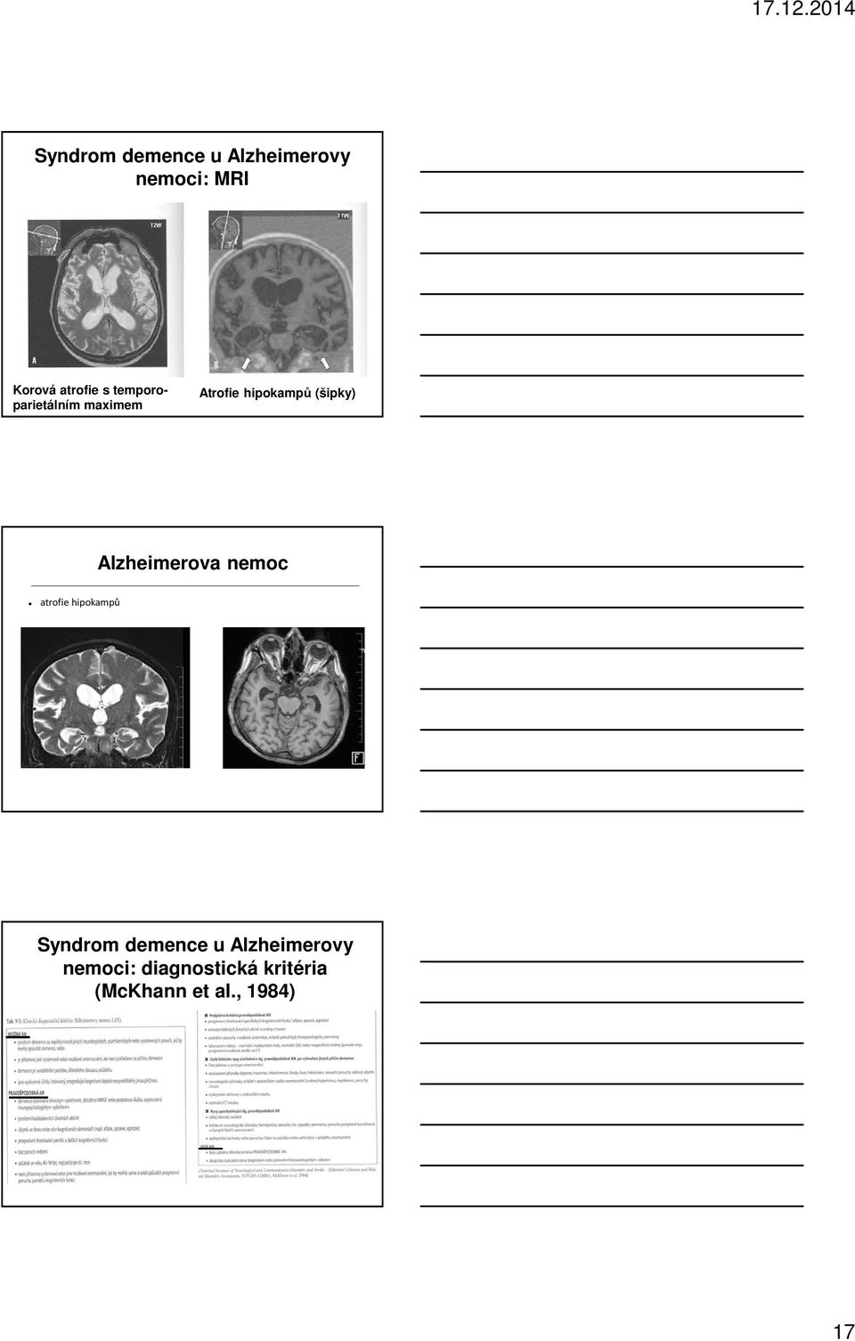 Alzheimerova nemoc atrofie hipokampů Syndrom demence u