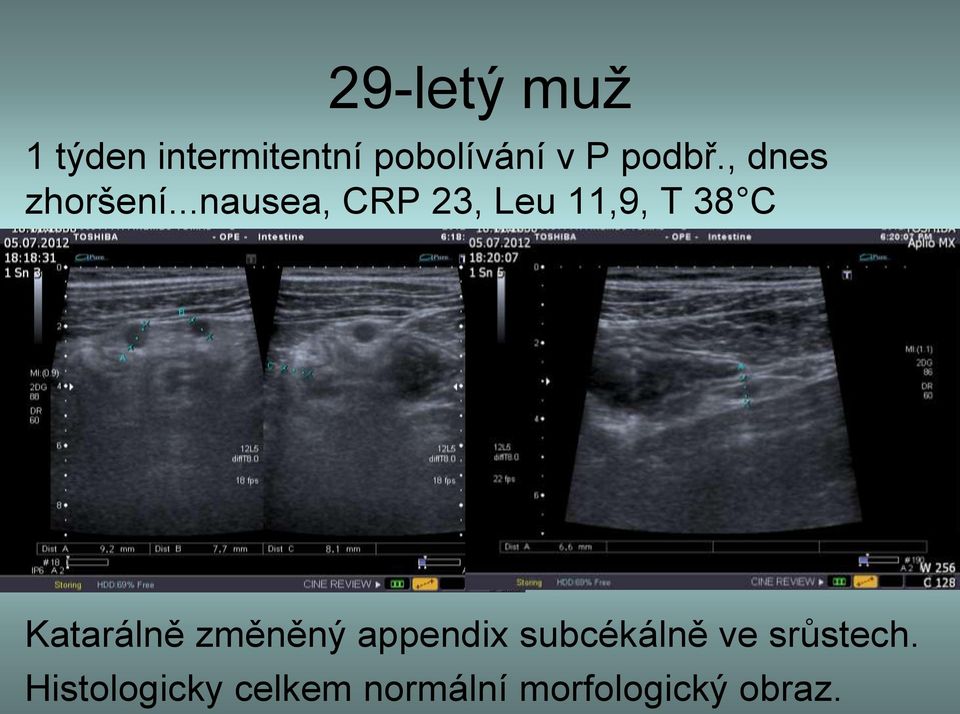 ..nausea, CRP 23, Leu 11,9, T 38 C Katarálně