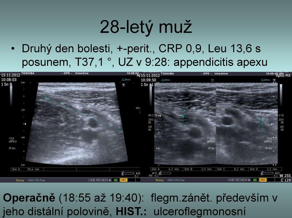 : ulceroflegmonosní 28-letý muž Druhý den bolesti,