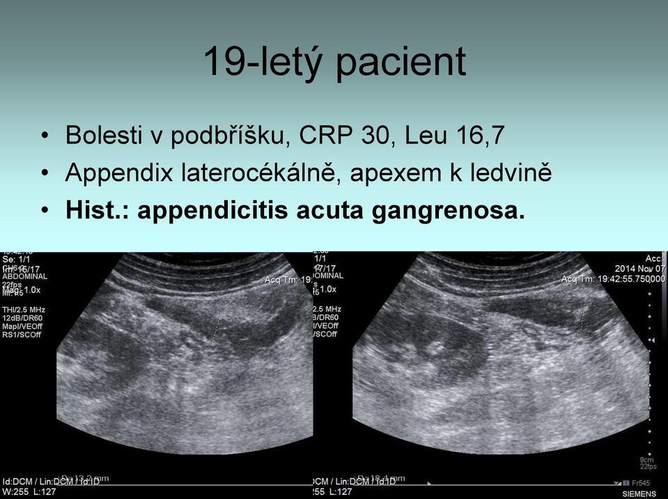 Appendix laterocékálně, apexem k