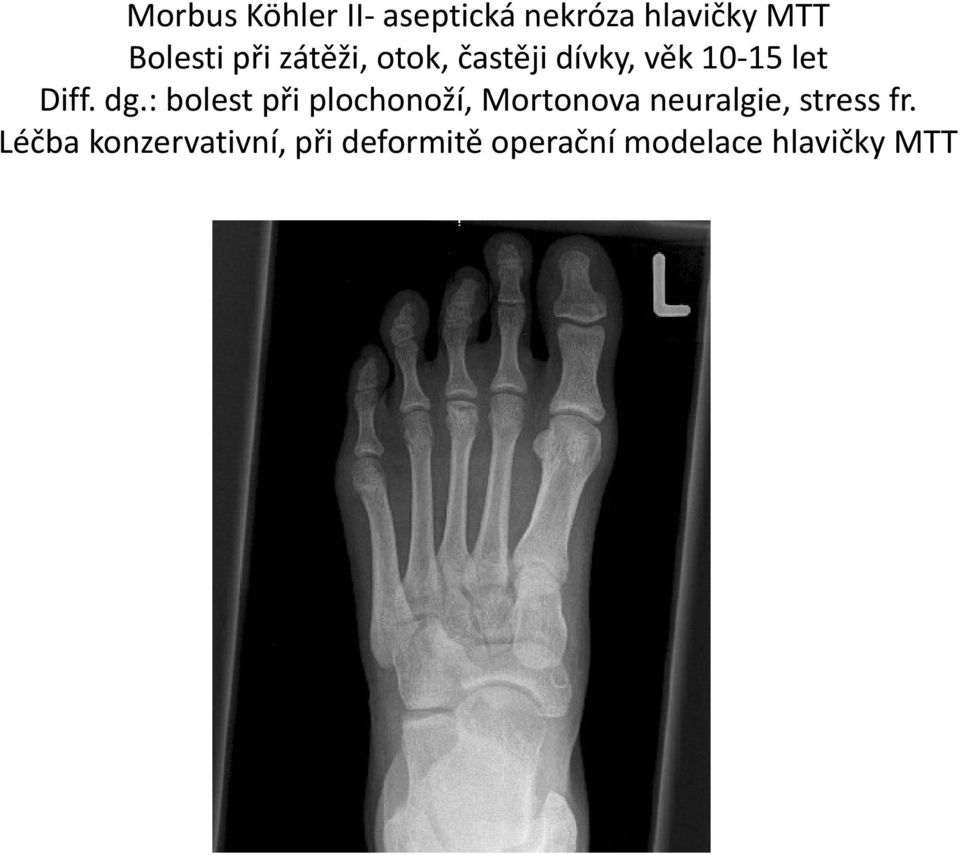 : bolest při plochonoží, Mortonova neuralgie, stress fr.