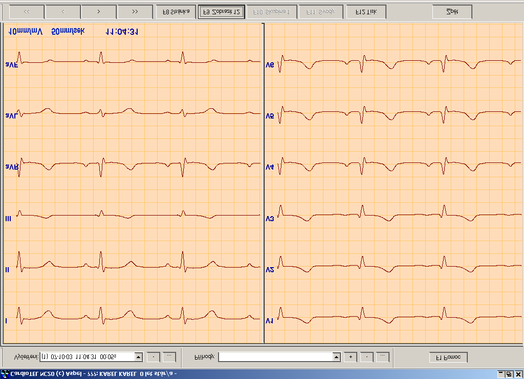 5.0. Zobrazení EKG Záznam vyšetření může být prohlížen dvěma způsoby: Mód stripu Mód stránky Mód stripu Mód stripu prezentuje záznam EKG ve všech kanálech současně (nebo ve vybraných kanálech).