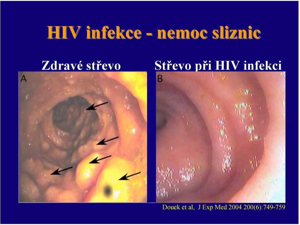 Střevo při HIV infekci