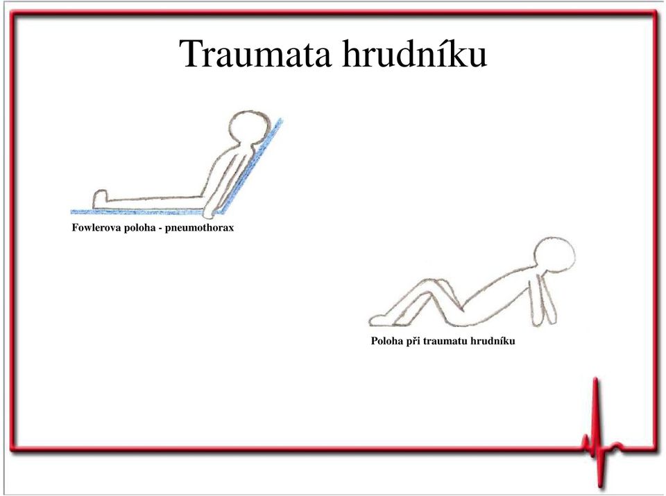 pneumothorax Poloha