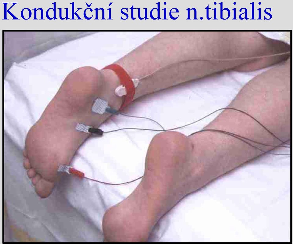 tibialis