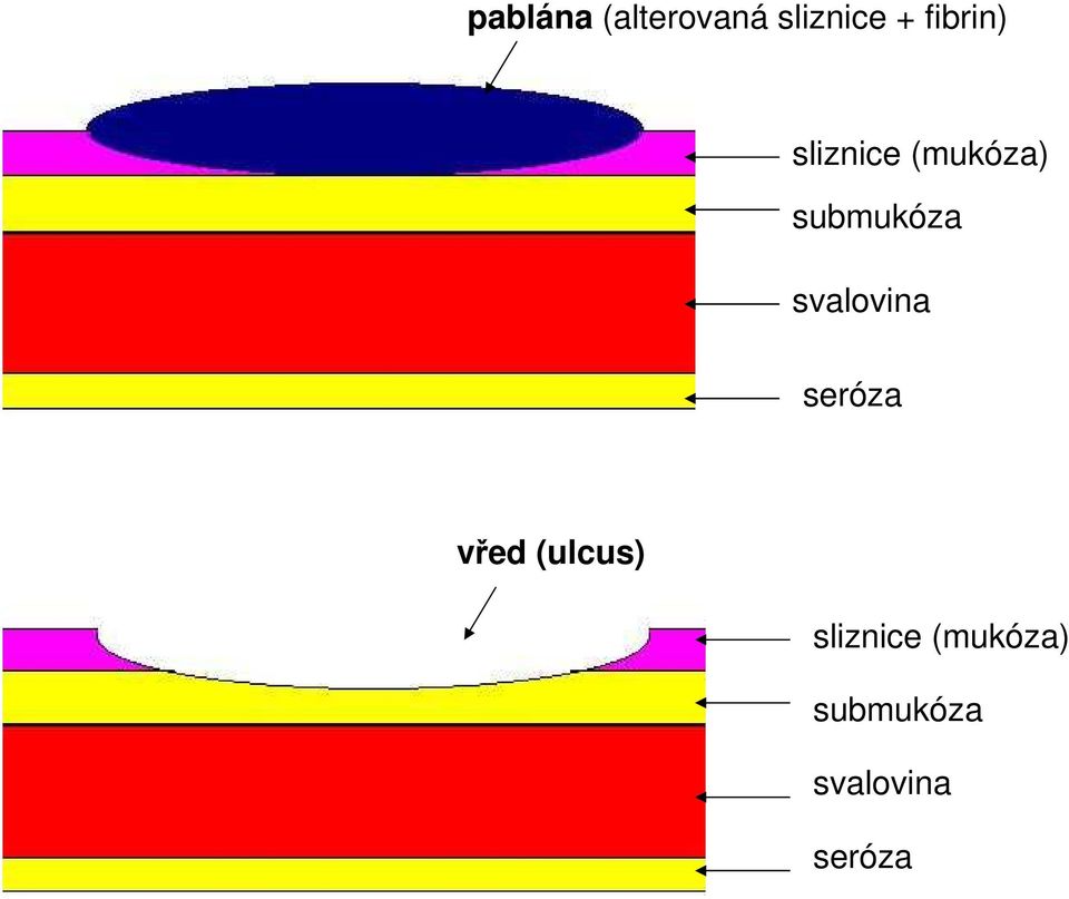 svalovina seróza vřed (ulcus)