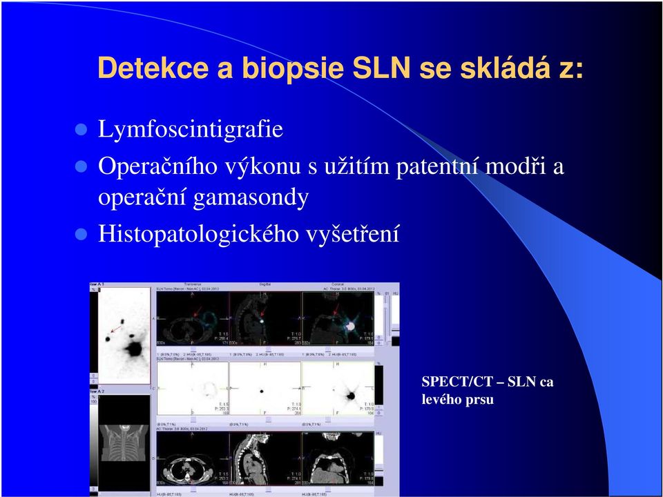 užitím patentní modři a operační gamasondy