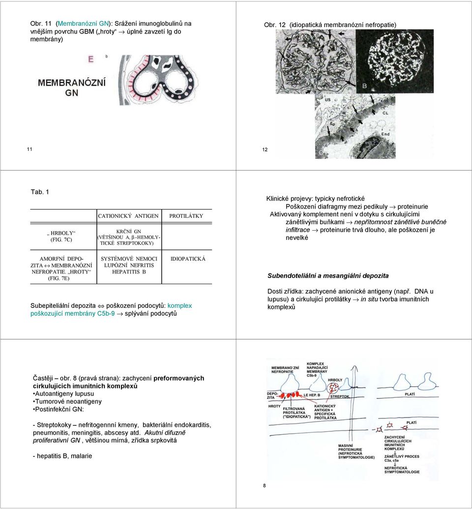 dotyku s cirkulujícími zánětlivými buňkami nepřítomnost zánětlivé buněčné infiltrace proteinurie trvá dlouho, ale poškození je nevelké AMORFNÍ DEPO- ZITA MEMBRANÓZNÍ NEFROPATIE. HROTY (FIG.