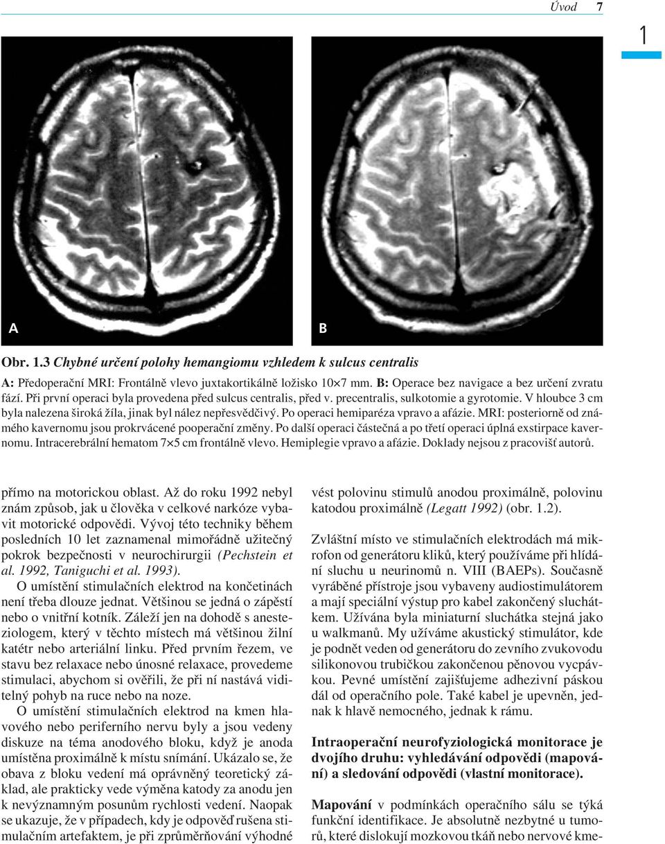 V hloubce 3 cm byla nalezena široká žíla, jinak byl nález nepřesvědčivý. Po operaci hemiparéza vpravo a afázie. MRI: posteriorně od známého kavernomu jsou prokrvácené pooperační změny.