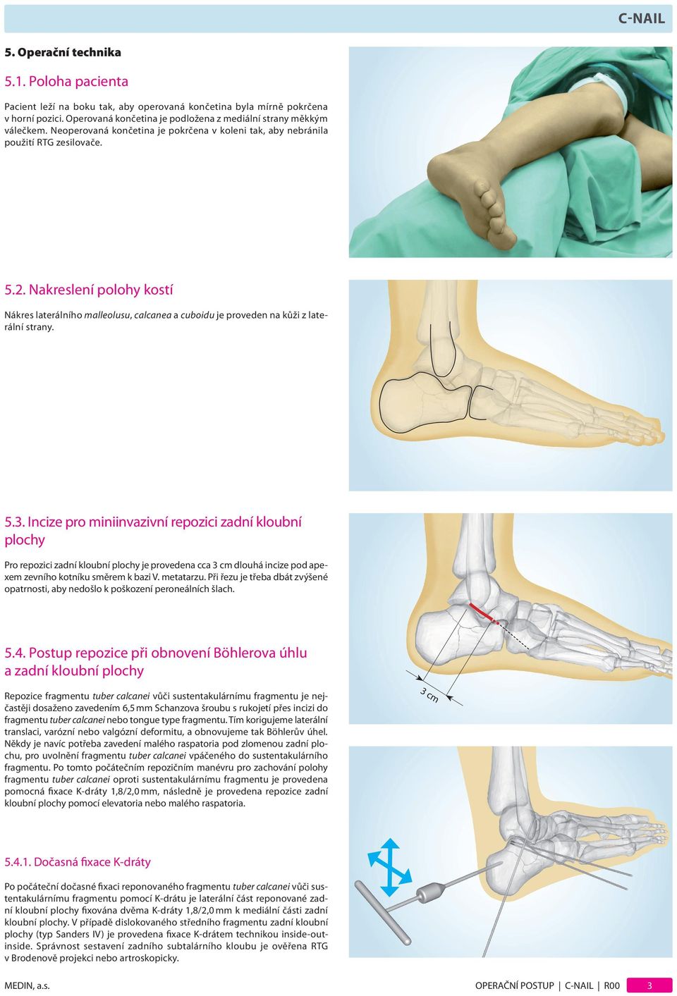 Nakreslení polohy kostí Nákres laterálního malleolusu, calcanea a cuboidu je proveden na kůži z laterální strany. 5.3.