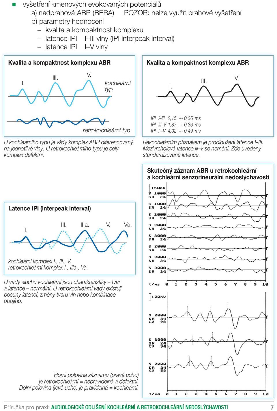 U retrokochleárního typu je celý komplex defektní. IPI I III 2,15 +- 0,36 ms IPI III V 1,87 +- 0,36 ms IPI I V 4,02 +- 0,49 ms Rekochleárním příznakem je prodloužení latence I III.