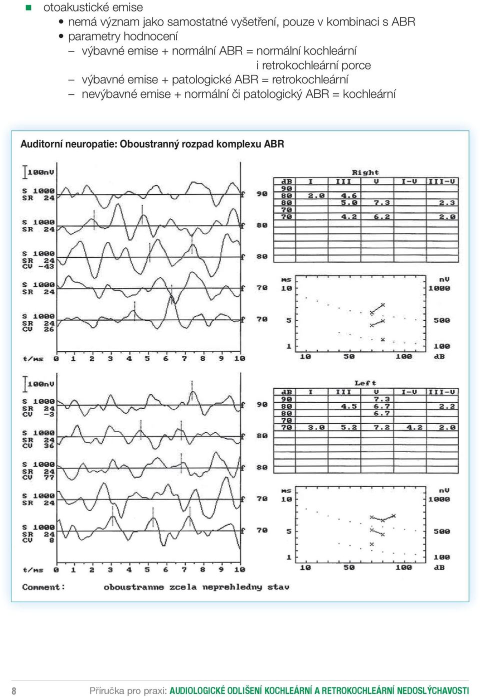 = retrokochleární nevýbavné emise + normální či patologický ABR = kochleární Auditorní neuropatie: