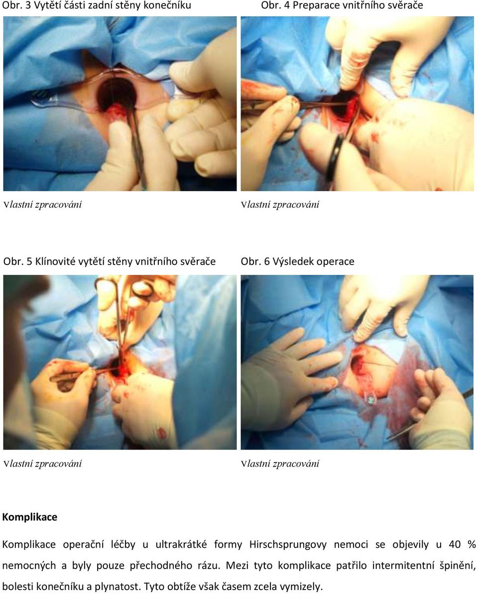 Výsledek operace Komplikace Komplikace operační léčby u ultrakrátké formy Hirschsprungovy nemoci se