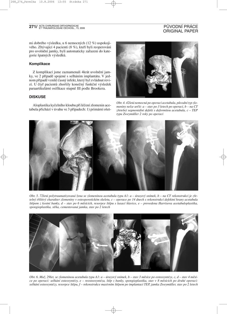 Komplikace Z komplikací jsme zaznamenali 4krát uvolnění jamky, ve 2 případě spojené s selháním implantátu. V jednom případě vznikl časný infekt, který byl zvládnut revizí.