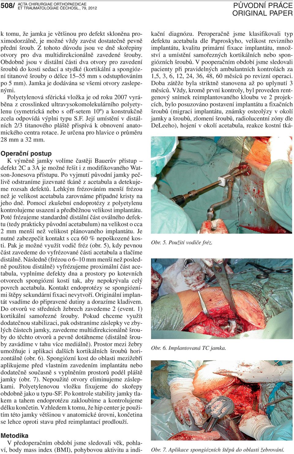 Obdobně jsou v distální části dva otvory pro zavedení šroubů do kosti sedací a stydké (kortikální a spongiózní titanové šrouby o délce 15 55 mm s odstupňováním po 5 mm).