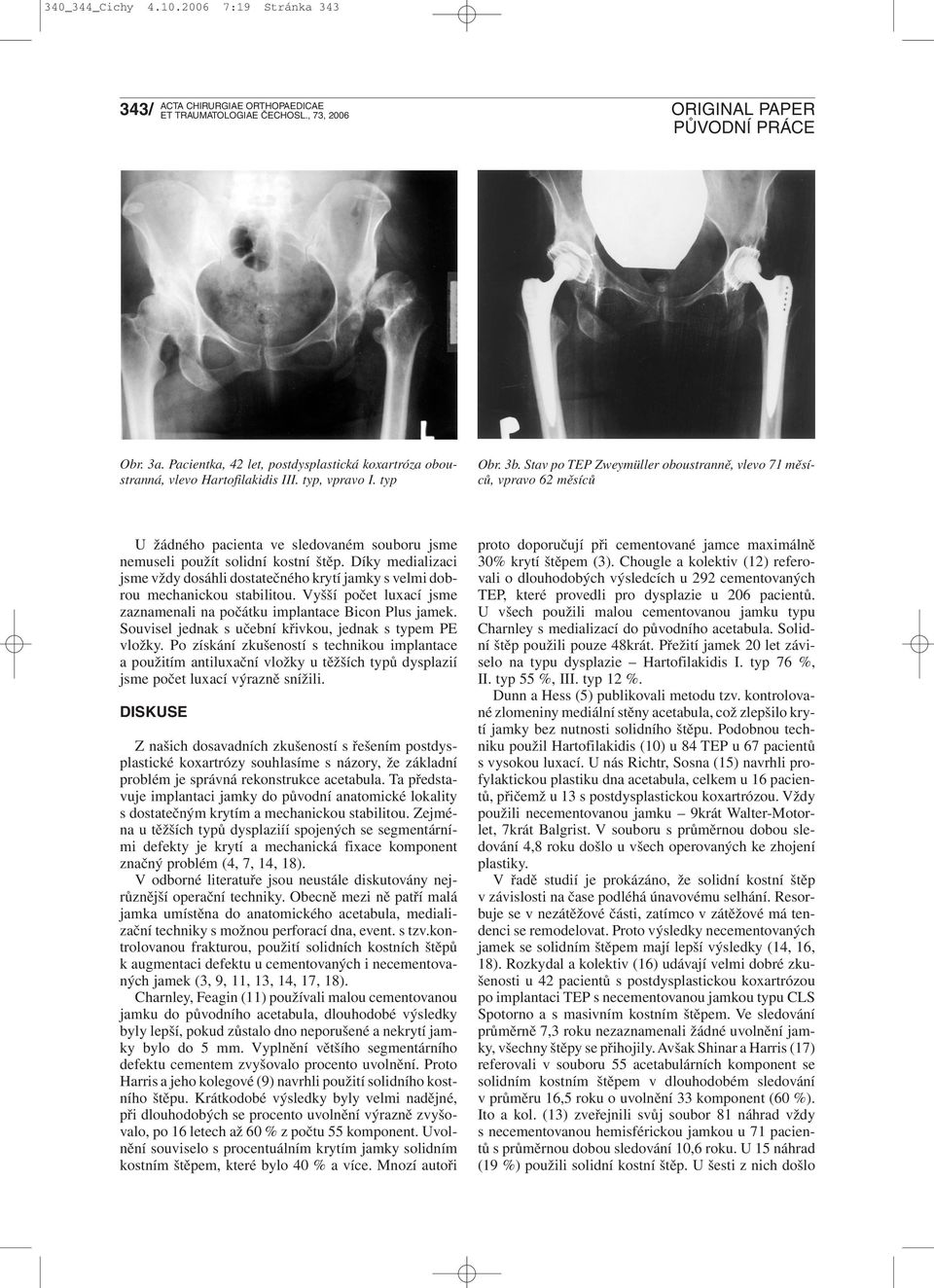 Díky medializaci jsme vždy dosáhli dostatečného krytí jamky s velmi dobrou mechanickou stabilitou. Vyšší počet luxací jsme zaznamenali na počátku implantace Bicon Plus jamek.