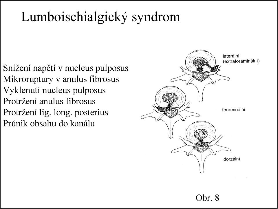 nucleus pulposus Protržení anulus fibrosus