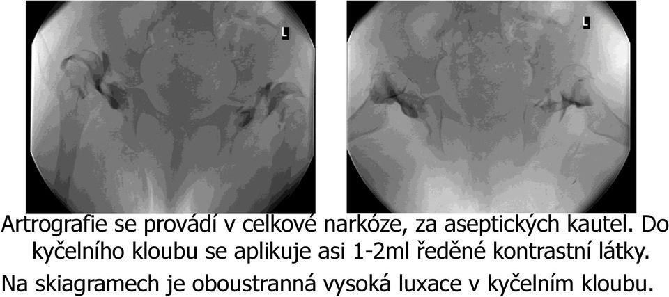 Do kyčelního kloubu se aplikuje asi 1-2ml ředěné