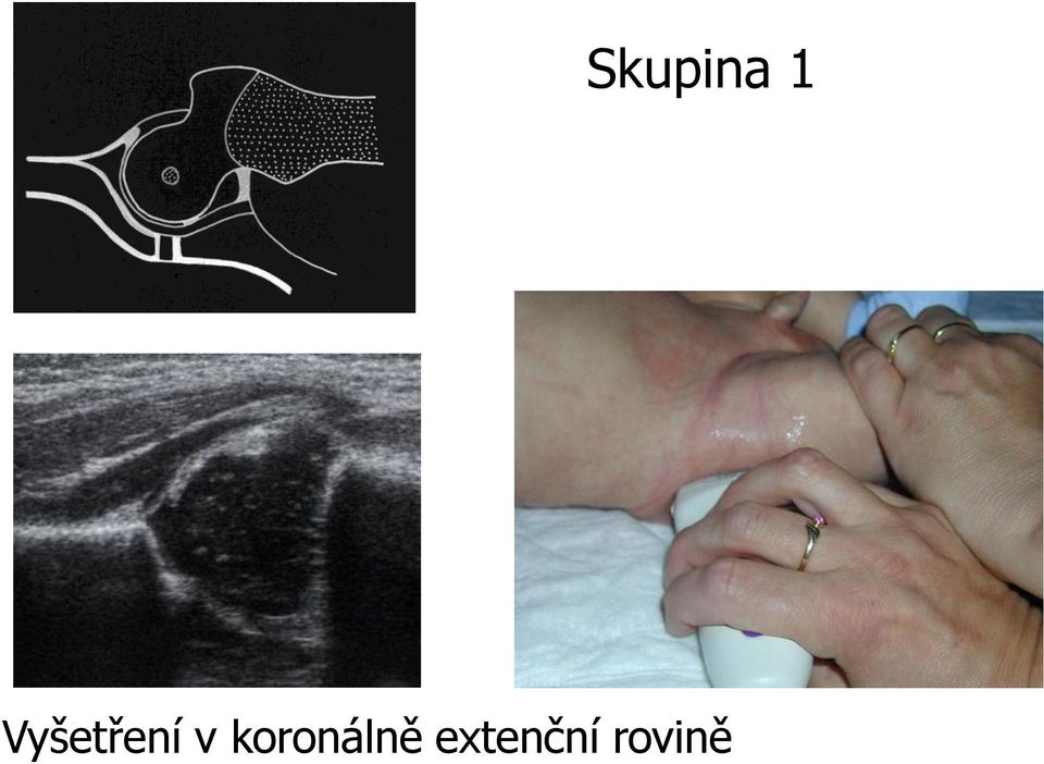 koronálně