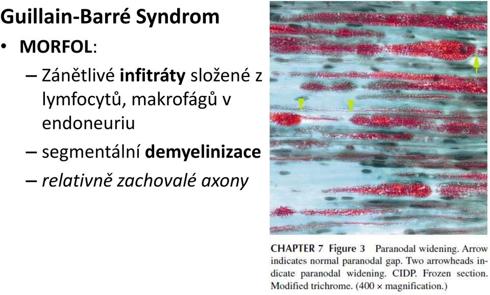 lymfocytů, makrofágů v endoneuriu