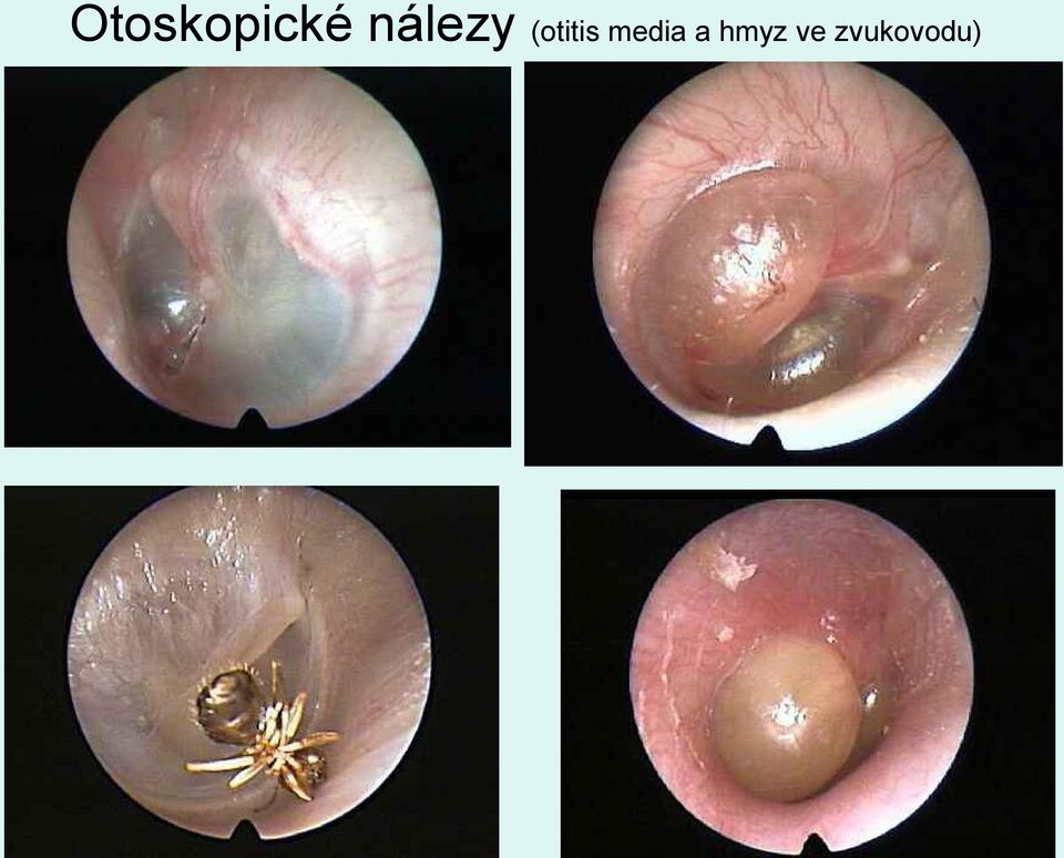 (otitis media