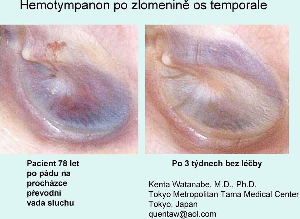 týdnech bez léčby Kenta Watanabe, M.D.