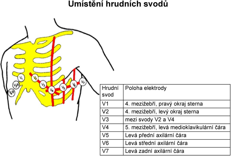 mezižebří, levý okraj sterna mezi svody V2 a V4 5.