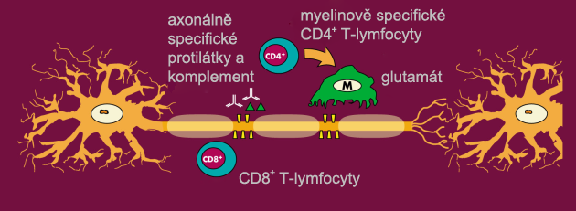 3 Axonální poškození v průběhu demyelinizace (Benešová, 2013) Havrdová (2012, s.