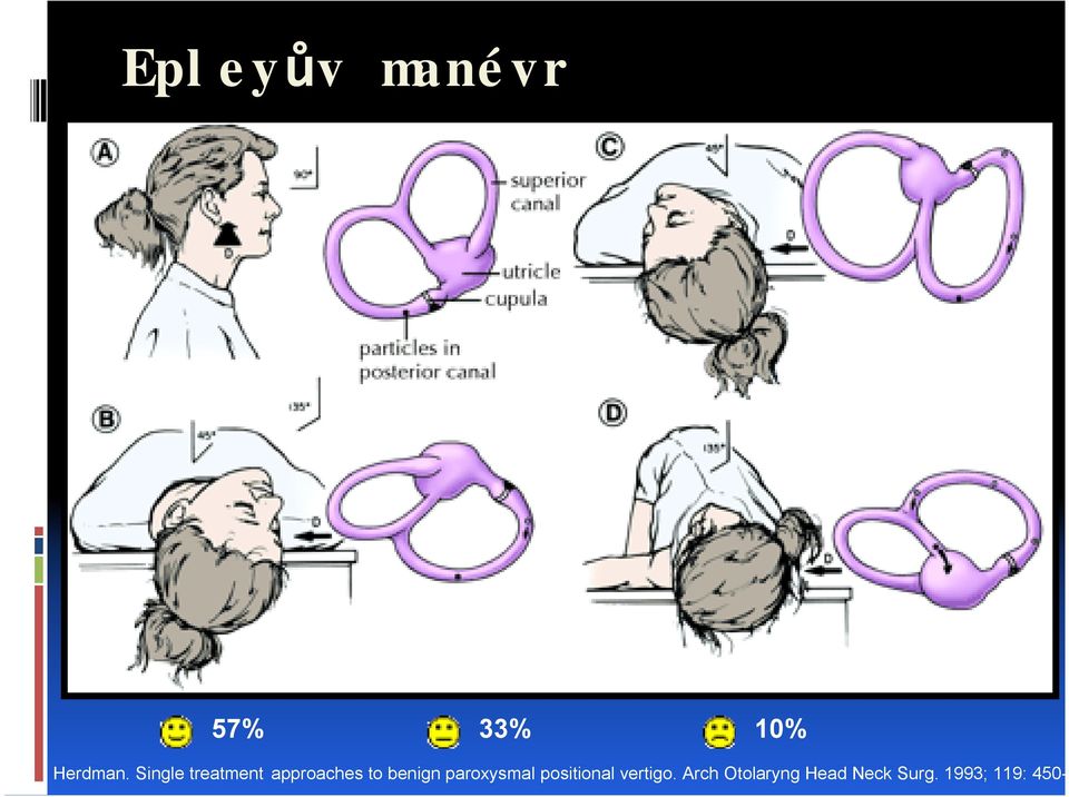 paroxysmal positional vertigo.