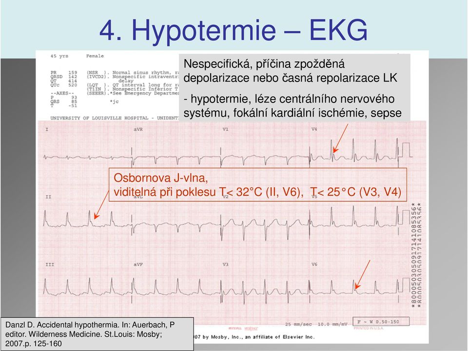 Osbornova J-vlna, viditelná při poklesu T< 32 C (II, V6), T< 25 C (V3, V4) Danzl D.