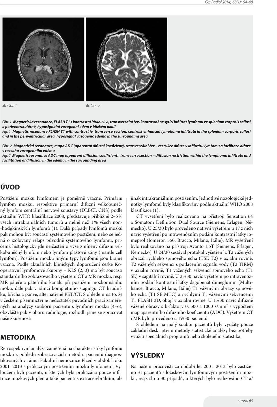 Magnetic resonance FLASH T1 with contrast iv, transverse section, contrast enhanced lymphoma infiltrate in the splenium corporis callosi and in the periventricular area, hyposignal vasogenic edema in