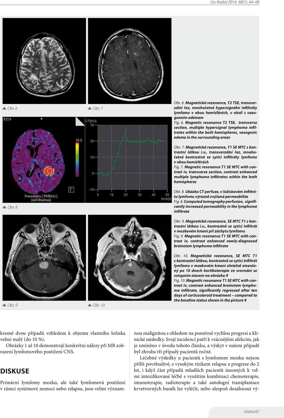 Magnetic resonance T1 SE MTC with contrast iv, transverse section, contrast enhanced multiple lymphoma infiltrates within the both hemispheres Obr. 8.