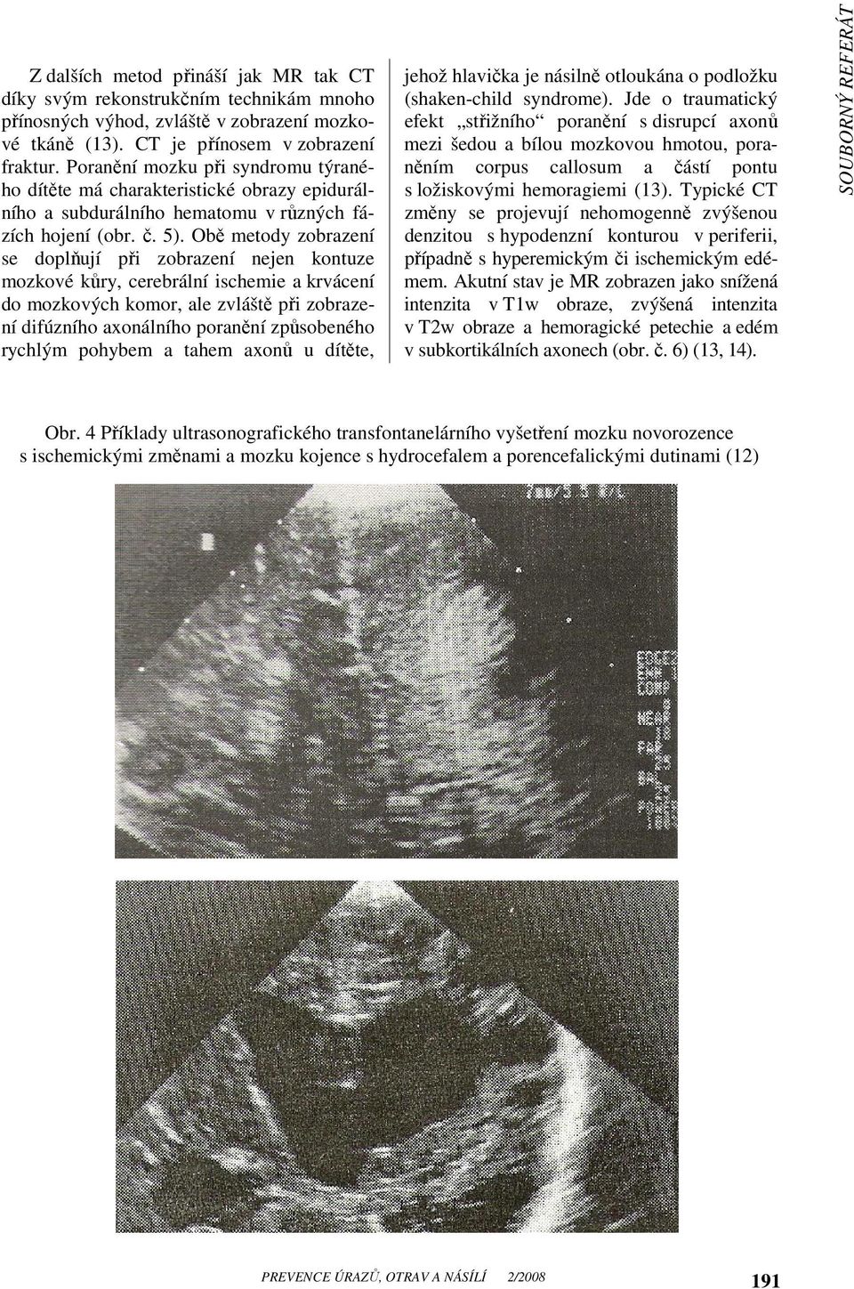 Typické CT změny se projevují nehomogenně zvýšenou denzitou s hypodenzní konturou v periferii, případně s hyperemickým či ischemickým edémem.