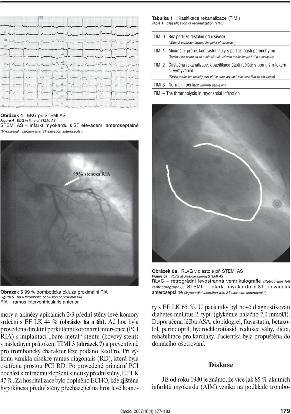 tokem či vymýváním (Partial perfusion, opacity part of the coronary bed with slow flow or clearance) TIMI 3 Normální perfuze (Normal perfusion) TIMI The thrombolysis in myocardial infarction Obrázek