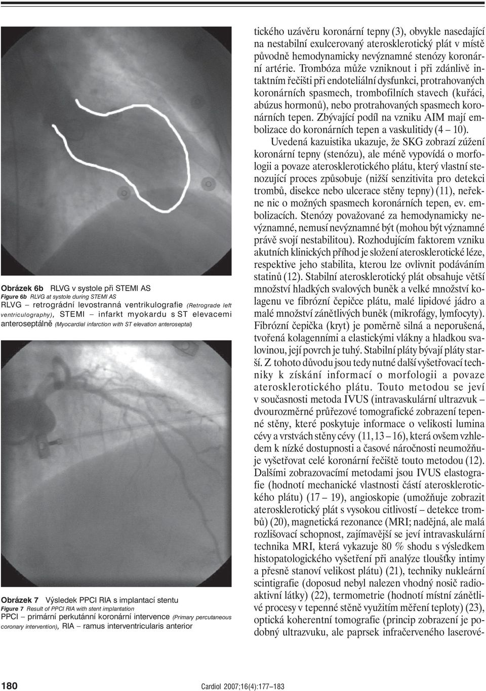 perkutánní koronární intervence (Primary percutaneous coronary intervention), RIA ramus interventricularis anterior tického uzávěru koronární tepny (3), obvykle nasedající na nestabilní exulcerovaný