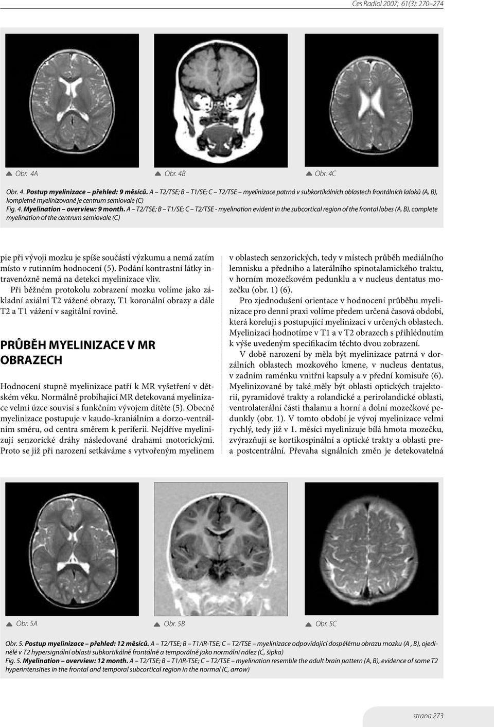 A T2/TSE; B T1/SE; C T2/TSE - myelination evident in the subcortical region of the frontal lobes (A, B), complete myelination of the centrum semiovale (C) pie při vývoji mozku je spíše součástí