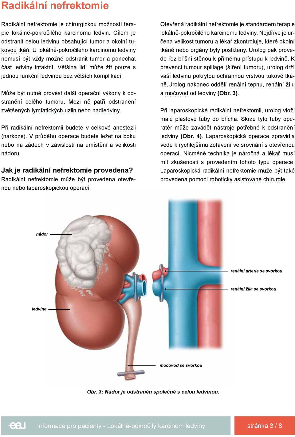 Může být nutné provést další operační výkony k odstranění celého tumoru. Mezi ně patří odstranění zvětšených lymfatických uzlin nebo nadledviny.