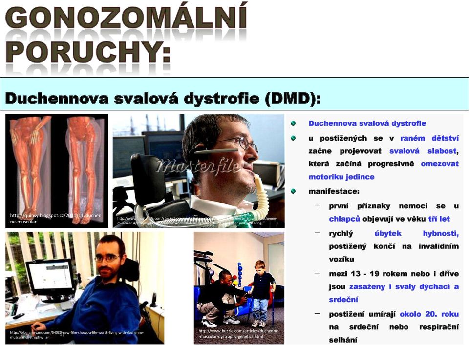 com/stock-photography/image/602-03837101/businessman-with-duchennemuscular-dystrophy-in-a-motorized-wheelchair-using-a-breathing-ventilator-and-a-hearing manifestace: první příznaky nemoci se u