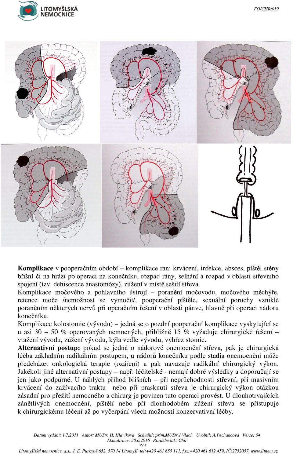 Komplikace močového a pohlavního ústrojí poranění močovodu, močového měchýře, retence moče /nemožnost se vymočit/, pooperační píštěle, sexuální poruchy vzniklé poraněním některých nervů při operačním