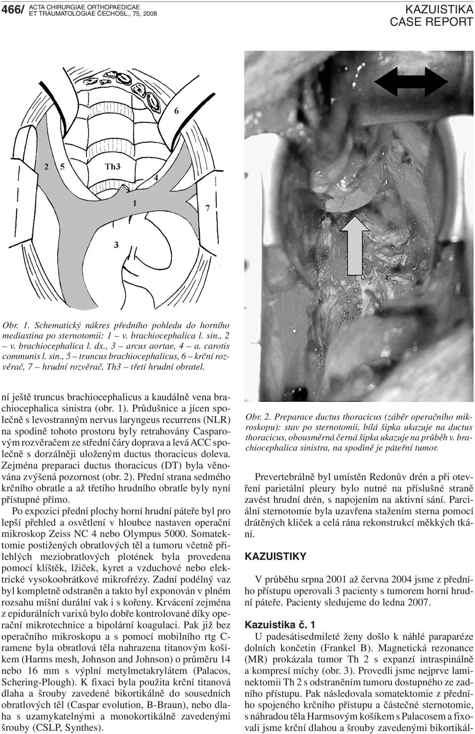 1 U padesátisedmileté ženy došlo k náhlé paraparéze dolních končetin (Frankel B). Magnetická rezonance (MR) prokázala tumor Th 2 s expanzí intraspinálně a kompresí míchy (obr. 3).