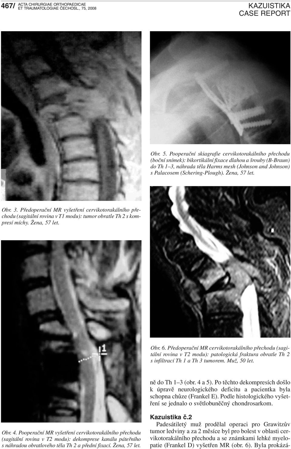 Žena, 57 let. Obr. 3. Předoperační MR vyšetření cervikotorakálního přechodu (sagitální rovina v T1 modu): tumor obratle Th 2 s kompresí míchy. Žena, 57 let. Obr. 6.