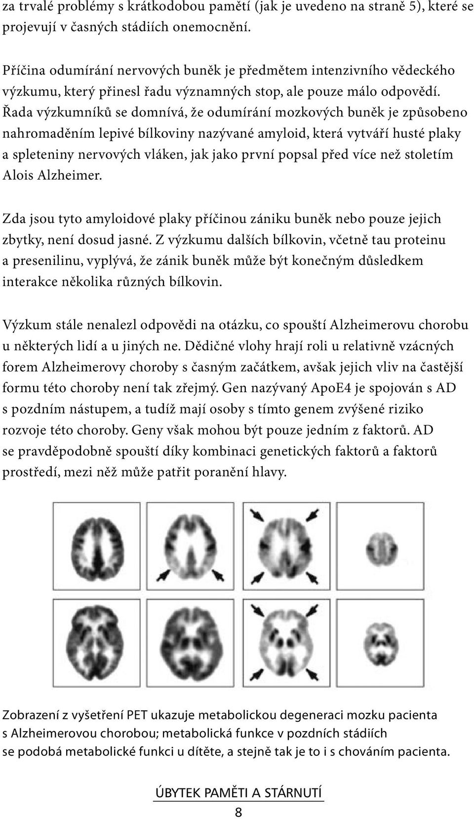 Řada výzkumníků se domnívá, že odumírání mozkových buněk je způsobeno nahromaděním lepivé bílkoviny nazývané amyloid, která vytváří husté plaky a spleteniny nervových vláken, jak jako první popsal