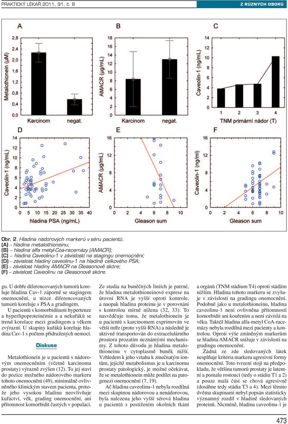 závislost hladiny AMACR na Gleasonovû skóre; (F) závislost Caveolinu na Gleasonovû skóre. gu.