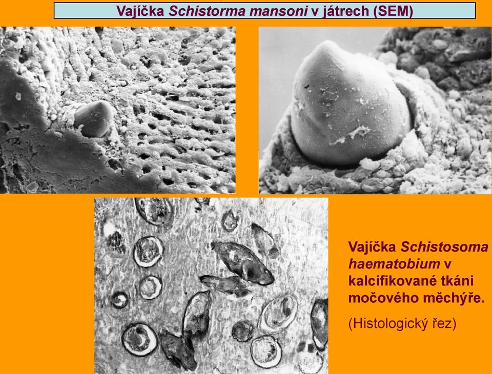 haematobium v kalcifikované tkáni