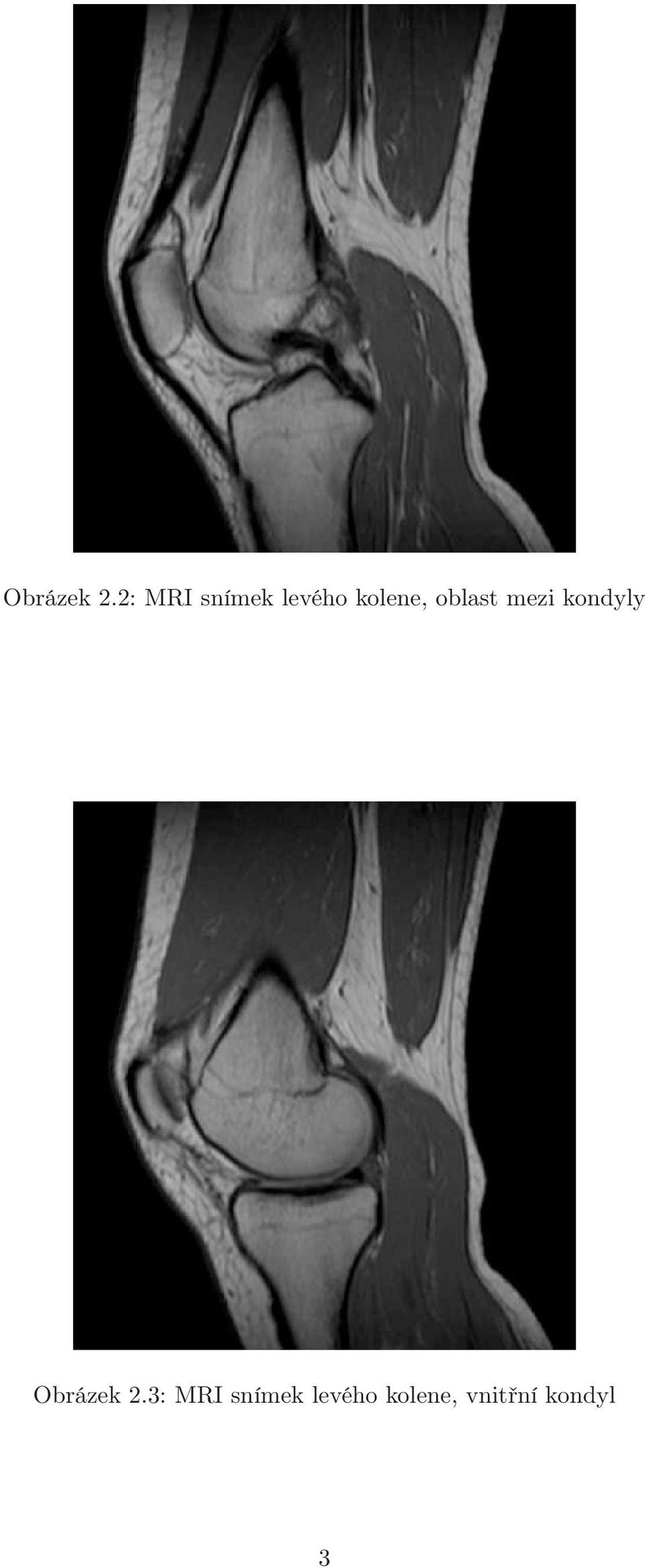 oblast mezi kondyly 3: MRI